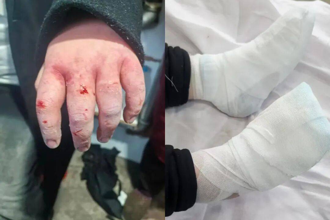 女大學生東北雪地裡摔暈後，3根手指或面臨截肢